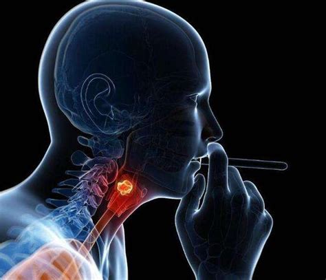 警惕喉癌的5大早期症状图片
